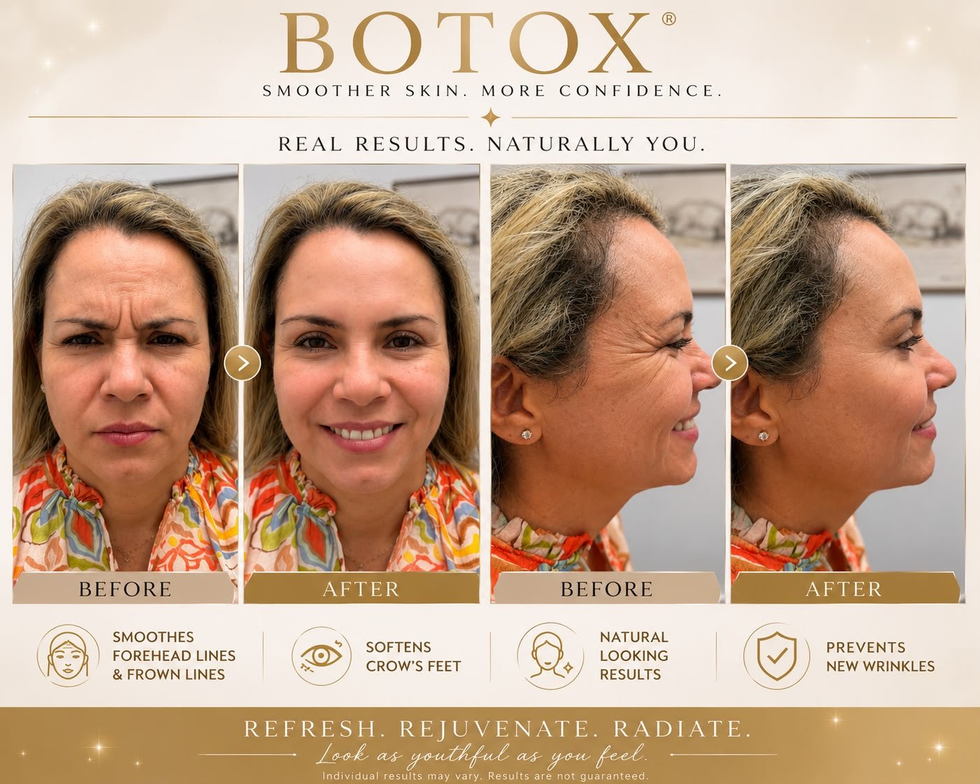 Botox before and after — patient 1