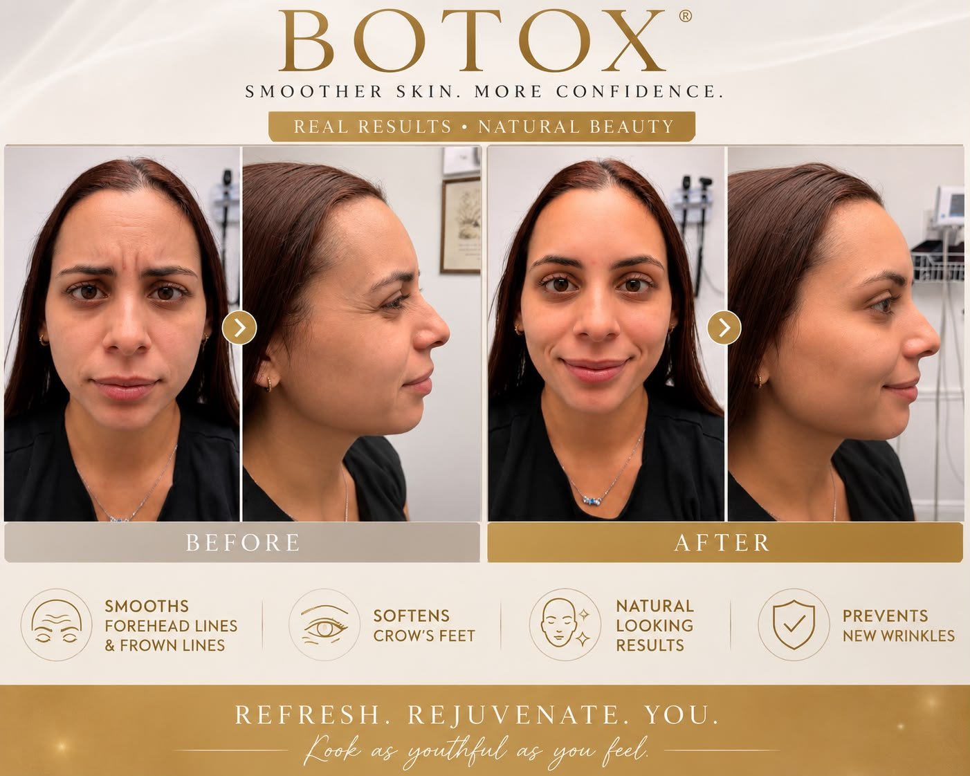 Botox before and after — patient 2